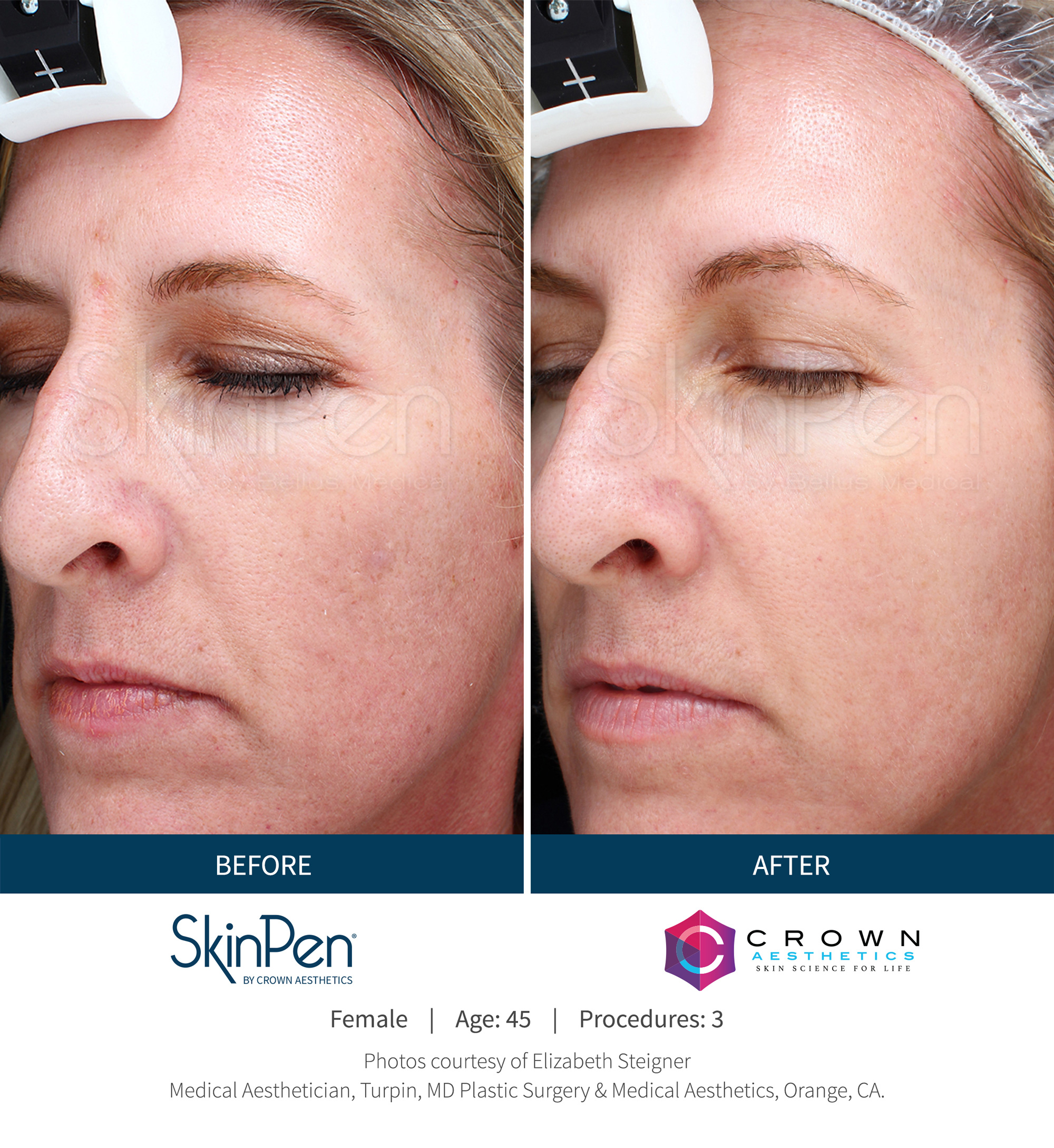 SKINPEN® MICRONEEDLING  - skinpen v n 2