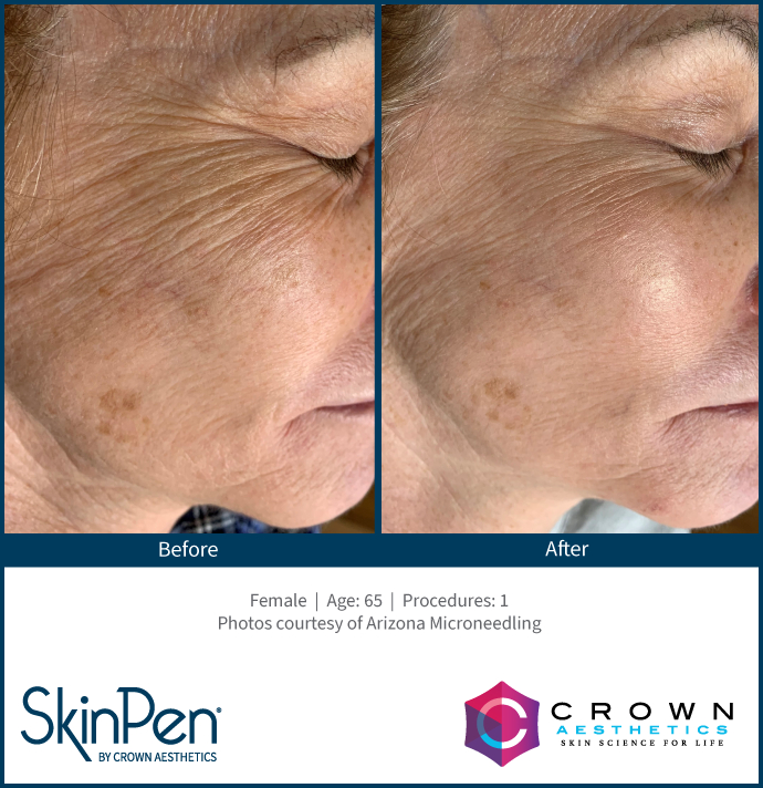 SKINPEN® MICRONEEDLING  - skinpen v n 3